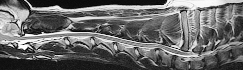 pg-hdr-cervical-spondylopathy