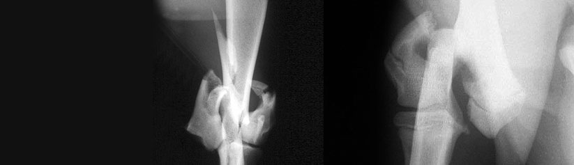 pg-hdr-humeral-condylar-fractures