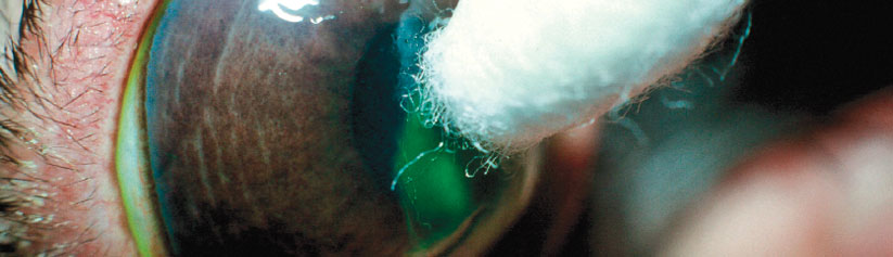 pg-hdr-recurrent-corneal-ulcer