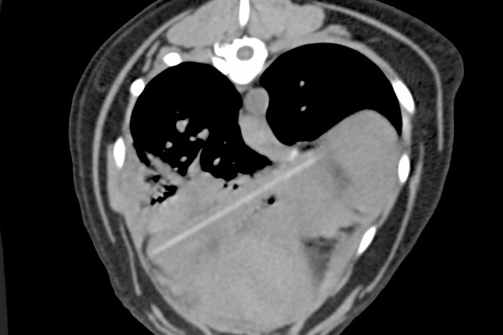 non-giforeign-bodies