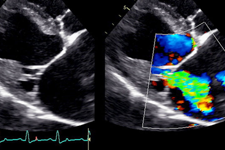 refractory-heart-failure-causes-and-treatment-options