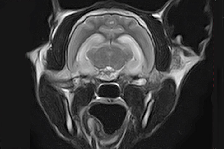 T2 weighted image showing hippocampal hyperintensity consistent with hippocampal necrosis or limbic encephalitis