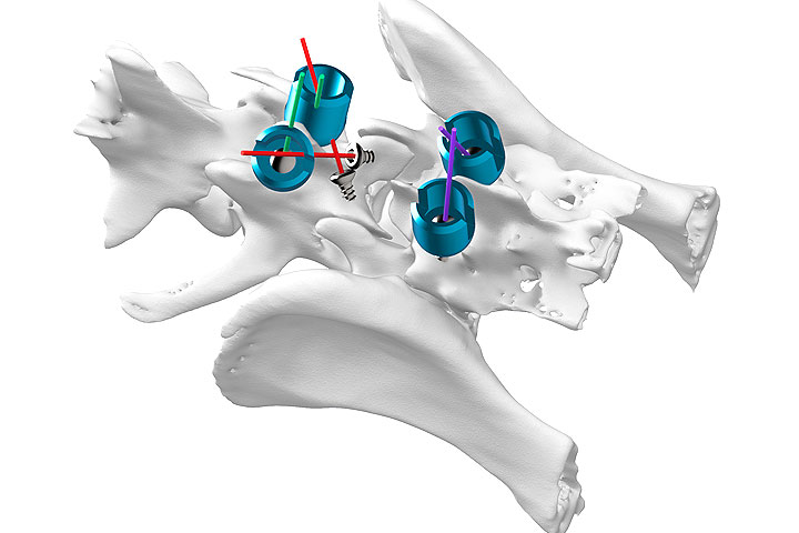 neurology-team-uses-novel-implants-for-spinal-care