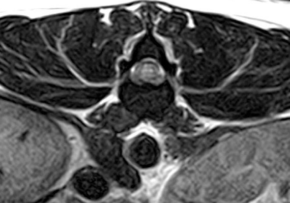 mri-image-of-t2-weighted-transverse-lumbar-spine-showing-the-spinal-cord-contusion
